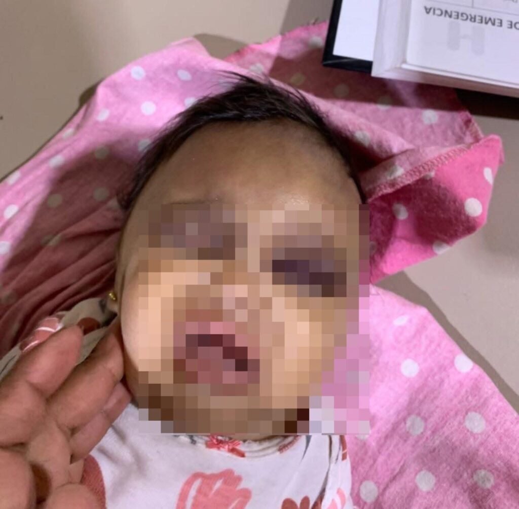 En estado crítico bebé de un mes de nacida que recibió brutal golpiza de su madre en Miches